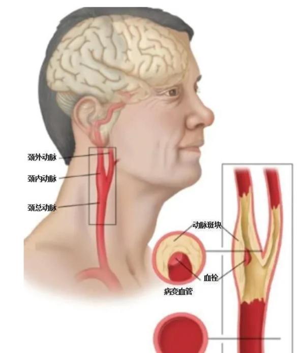 危险的颈动脉斑块 第2张